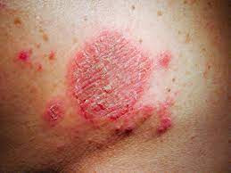 Dermatitis Numularis