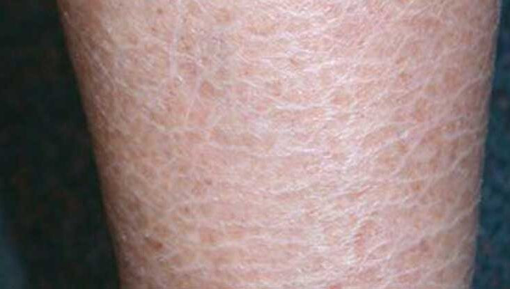 Iktiosis Vulgaris