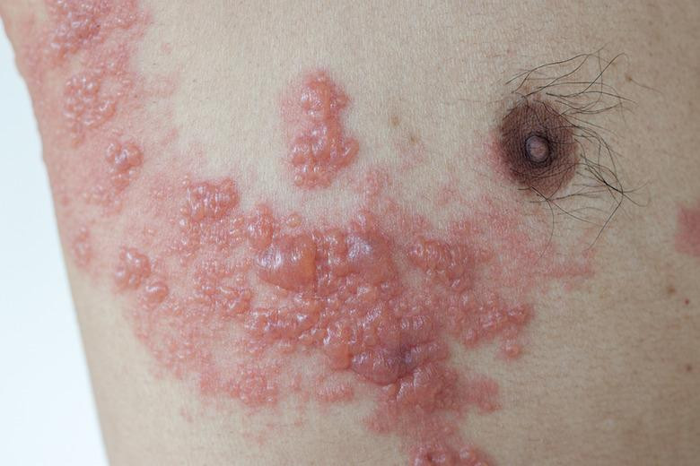 Cacar Ular (Herpes Zoster)