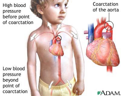 Koarktasio Aorta