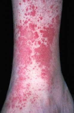 Vaskulitis Hipersensitivitas