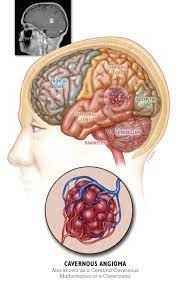 Hemangioma Kavernosa