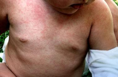 Roseola