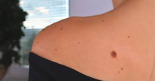 Tahi Lalat (Nevus Pigmentosus)
