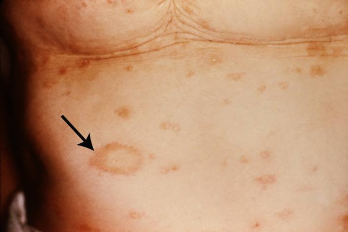 Pitiriasis Rosea