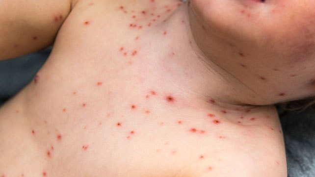 Cacar Air (Varicella Zoster)