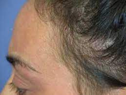 Telogen Effluvium