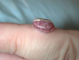 Granuloma Piogenik