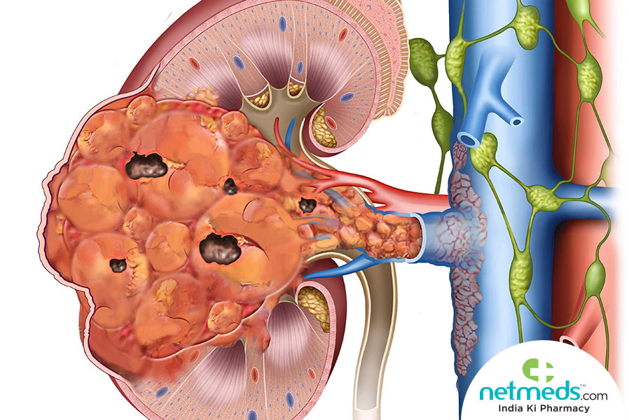 Tumor Wilms (Nefroblastoma)