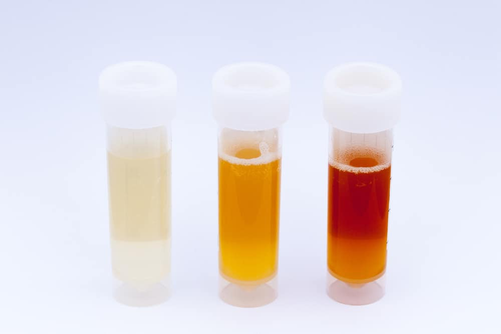 Hematuria