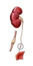 Ureterolitiasis