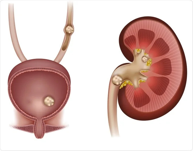 Batu Saluran Kemih (Urolitiasis)