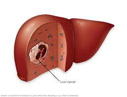Kanker Hepatoselular