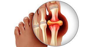 Gout Arthritis