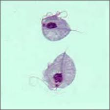 Trikomoniasis