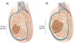 Seminoma