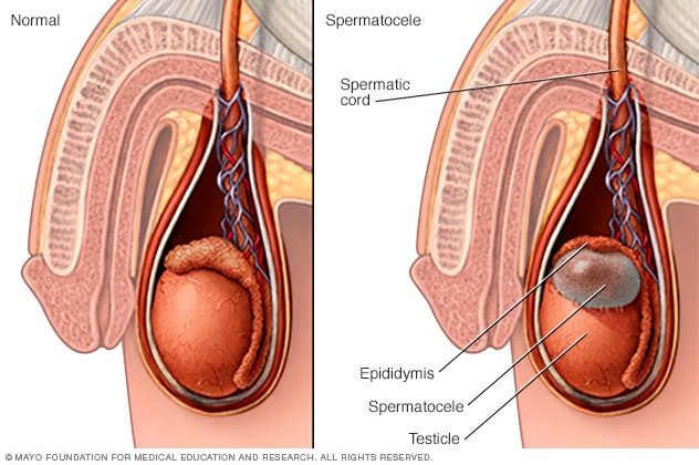 Spermatokel