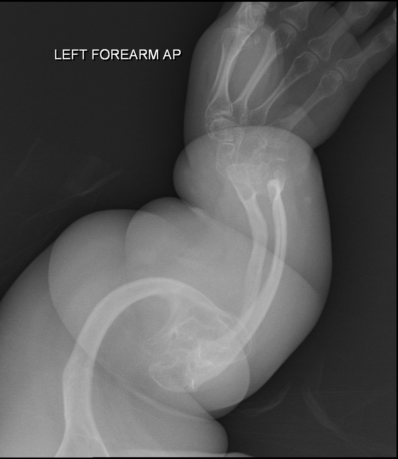 Osteogenesis Imperfekta
