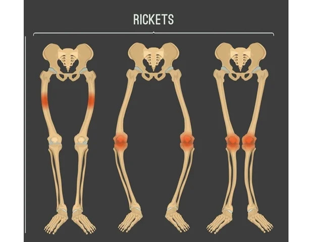 Rakitis