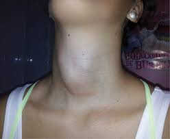 Goiter pada Anak