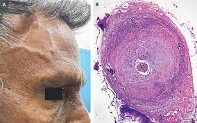 Giant Cell Arteritis