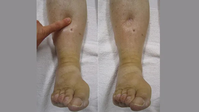 Edema Anasarka