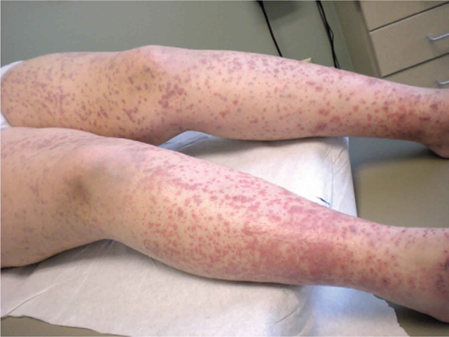 Disseminated Intravascular Coagulation (DIC)