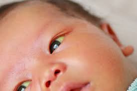 Breastfeeding/Breast milk Jaundice