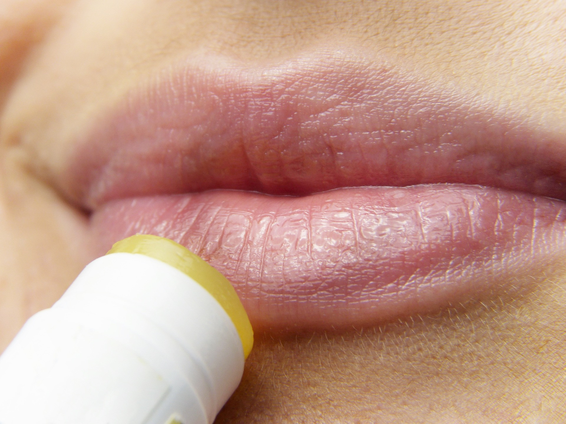 Herpes Oral