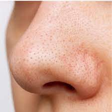 Perbedaan Antara Sebaceous Filaments dan Komedo Hitam