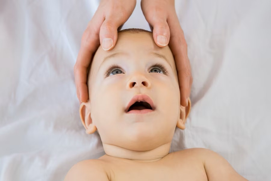 Craniosynostosis, Ketika Ubun-Ubun Bayi Menutup Lebih Cepat