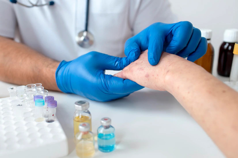 Perbedaan Status Suspek, Probable dan Konfirmasi pada Cacar Monyet (Monkeypox)