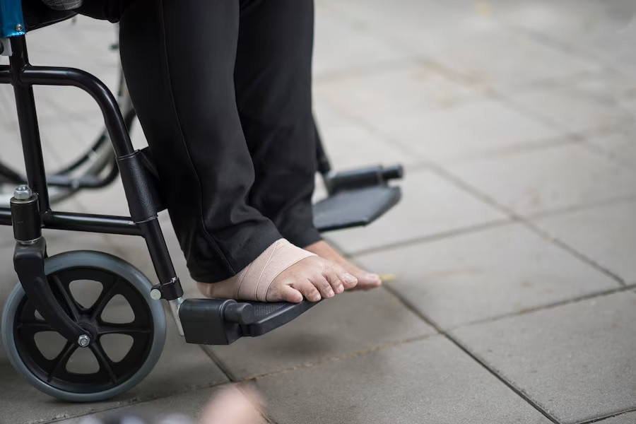 Risiko Amputasi Kaki pada Penderita Diabetes