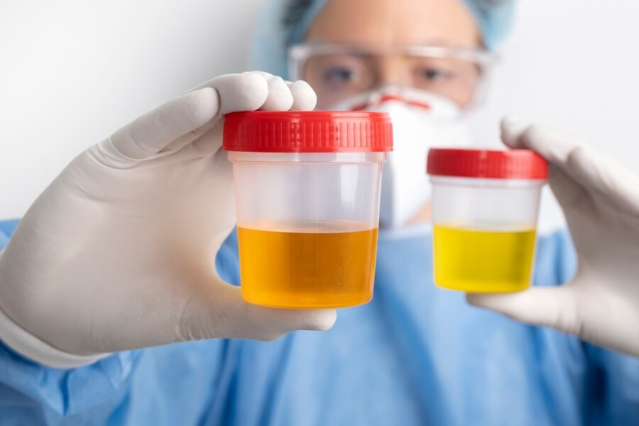 Urine Berwarna Cokelat Gelap, Ini Penyebabnya