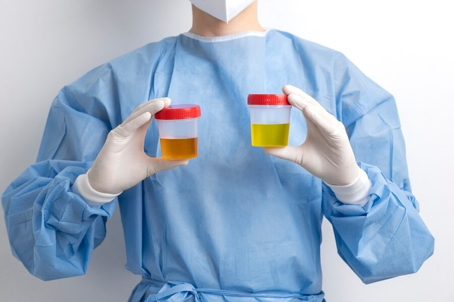 Apa Itu Glikosuria, Kondisi Ketika Terdapat Gula dalam Urine?