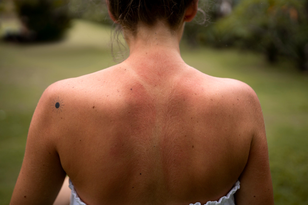 Mengenal Kondisi Sun Poisoning, Kerusakan Kulit Parah Akibat Paparan Sinar Matahari