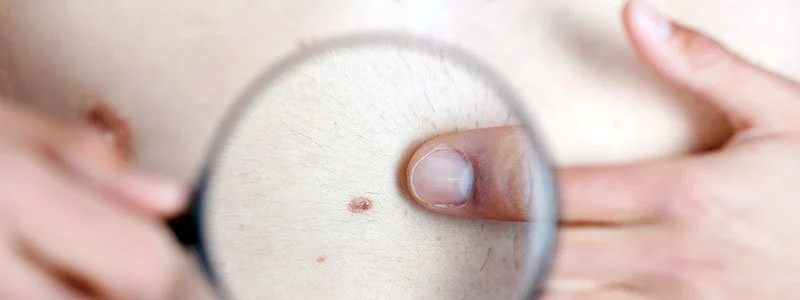 Ini Beda Tahi Lalat Normal dan Gejala Melanoma