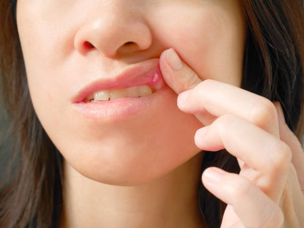 Beda Pengobatan, Kenali Perbedaan Antara Sariawan dan Herpes Oral